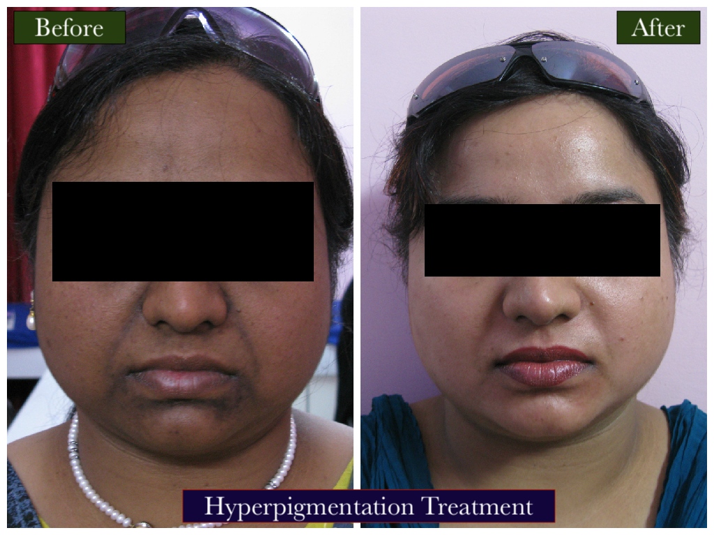 Hyperpigment Treatment